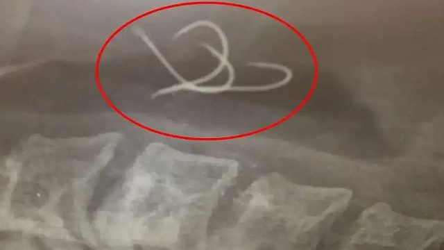 Αγρίνιο: Ώρες αγωνίας για 38χρονο που έφαγε χταπόδι μαζί με το αγκίστρι – Εσπευσμένα στην Αθήνα