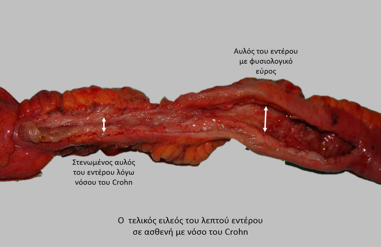 Νόσος Crohn