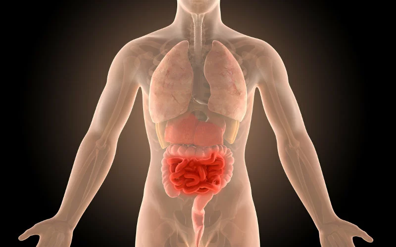 Νόσος Crohn