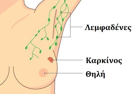 Καρκίνος μαστού