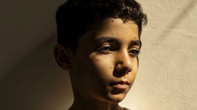 World Press Photo: Φωτογραφία της χρονιάς ένα διπλά ακρωτηριασμένο παιδί από την Παλαιστίνη