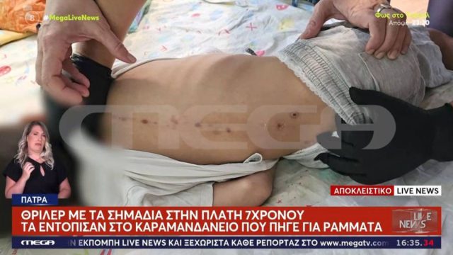 «Το παιδί έχει κακοποιηθεί»: Ανατριχιάζουν οι εικόνες από τα σημάδια στην πλάτη 7χρονου ΑμεΑ
