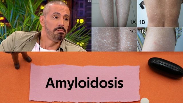 Τι είναι η αμυλοείδωση, η σπάνια ασθένεια του Γιώργου Παράσχου – Τα συμπτώματα, οι μορφές και η θεραπεία