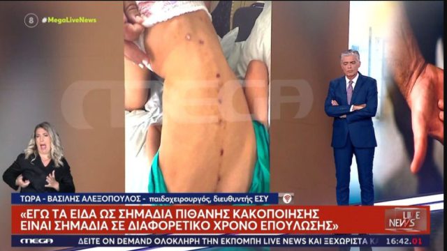 Κακοποίηση ή ατύχημα; Διαφορετικές εκδοχές για τα σημάδια στο σώμα του 10χρονου ΑμεΑ στην Πάτρα