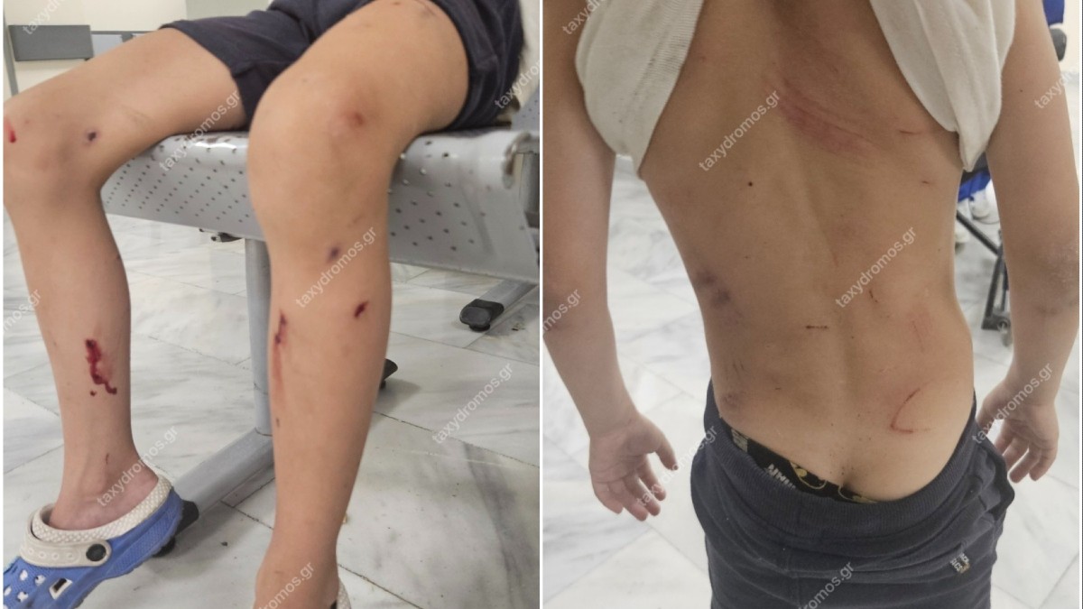 Συναγερμός στο Βόλο: Αδέσποτα κατασπάραξαν 7χρονο παιδί
