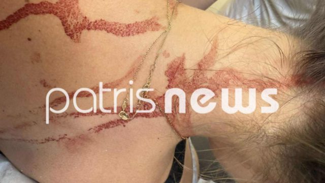 Άγριος καβγάς γυναικών στην Αμαλιάδα: Μπούκαρε σε κατάστημα και της κάρφωσε ψαλίδι στην πλάτη