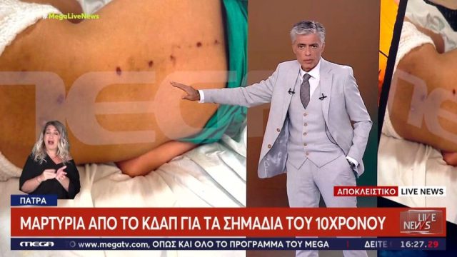 «Φανταστείτε να κακοποιείται εκτός οικογένειας»: Σε διαφορετικό χρόνο έγιναν τα σημάδια στο σώμα του 10χρονου ΑμεΑ
