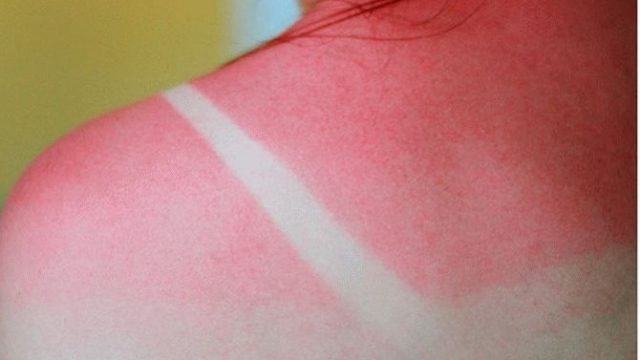 Ηλιακά εγκαύματα: Πώς να τα αντιμετωπίσεις γρήγορα και αποτελεσματικά στο σπίτι