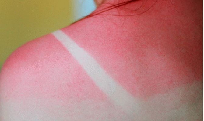 Ηλιακά εγκαύματα: Πώς να τα αντιμετωπίσεις γρήγορα και αποτελεσματικά στο σπίτι
