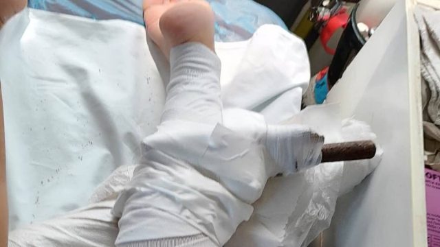 Σοκ στη Χαλκιδική: Ομπρέλα καρφώθηκε στο πόδι 26χρονης – Φυσούσαν θυελλώδεις άνεμοι