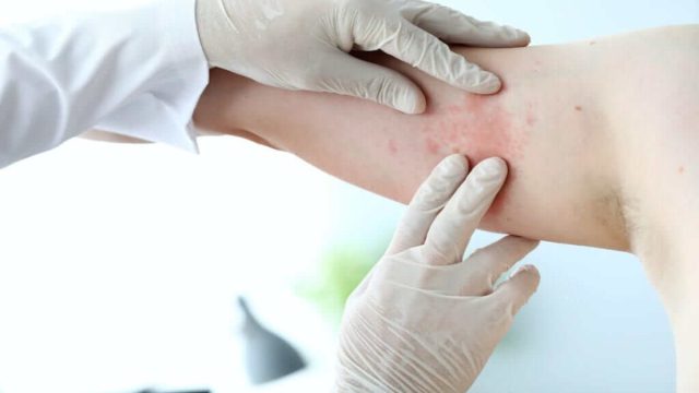 Ατοπική δερματίτιδα: Τι είναι και από τι προκαλείται η χρόνια πάθηση