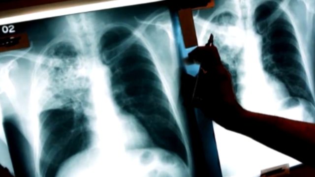 Θετικός στην φυματίωση άνδρας από την Καστοριά – Δε βρίσκεται σε καθεστώς καραντίνας
