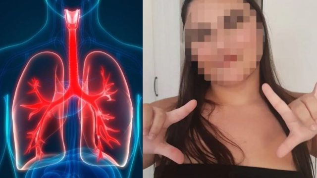 Τι είναι το πνευμονικό οίδημα από το οποίο πέθανε η 16χρονη κοπέλα στο Γκάζι
