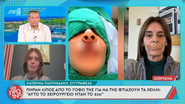 «Πήραν λίπος από τον γοφό για να μου φτιάξουν τα χείλη»: Η Κατερίνα Πλουμιδάκη για το λάθος του πλαστικού χειρουργού της