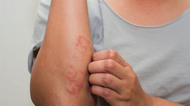 Παγκόσμια Ημέρα Ψωρίασης: Όσα πρέπει να γνωρίζετε για το αυτοάνοσο νόσημα
