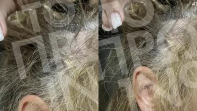 Δάφνη: Ποινική δίωξη στον πλαστικό χειρουργό που ξυλοκόπησε 43χρονη οδηγό