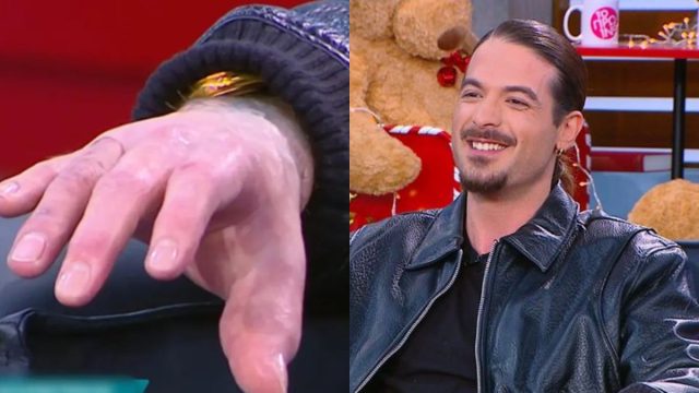 «Το χαϊδέψανε και μου είπανε “μπαμπά, το μιμί πέρασε”»: Ο Άρης Μουγκοπέτρος έδειξε στο «Πρωινό» τα πρόσθετα δάχτυλά του