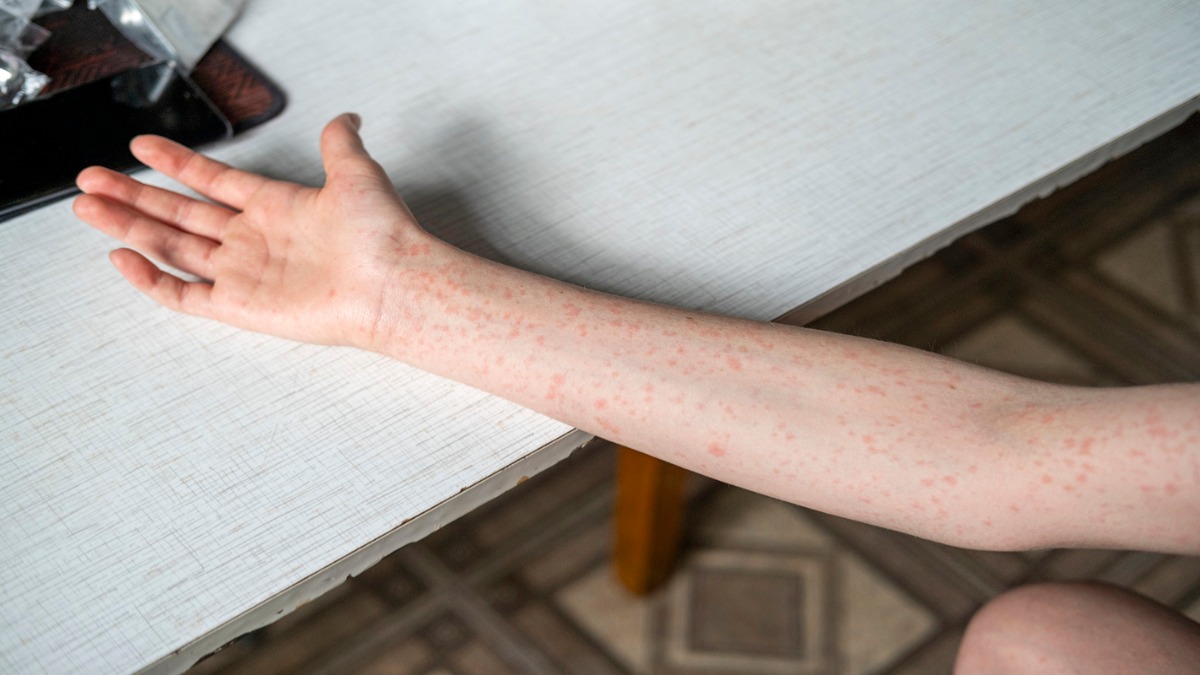 Συναγερμός στις ΗΠΑ: Η «πιο μεταδοτική νόσος στον κόσμο» στέλνει εκατοντάδες σε καραντίνα – Τι θα γίνει στην Ευρώπη;