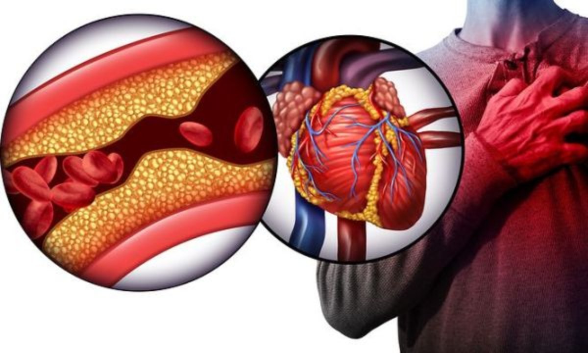Ένα Holter ρυθμού για 48 ώρες έδωσε την απάντηση που αναζητούσε: κολποκοιλιακός αποκλεισμός δευτέρου βαθμού τύπου 1