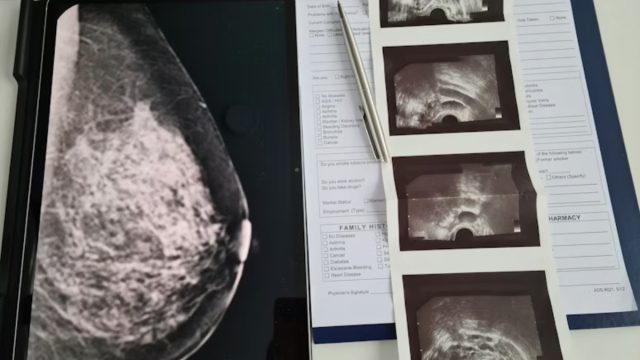 Ανησυχητικά νέα για τις γυναίκες: Πώς ο καρκίνος εξαρτάται από τη χώρα στην οποία ζούμε