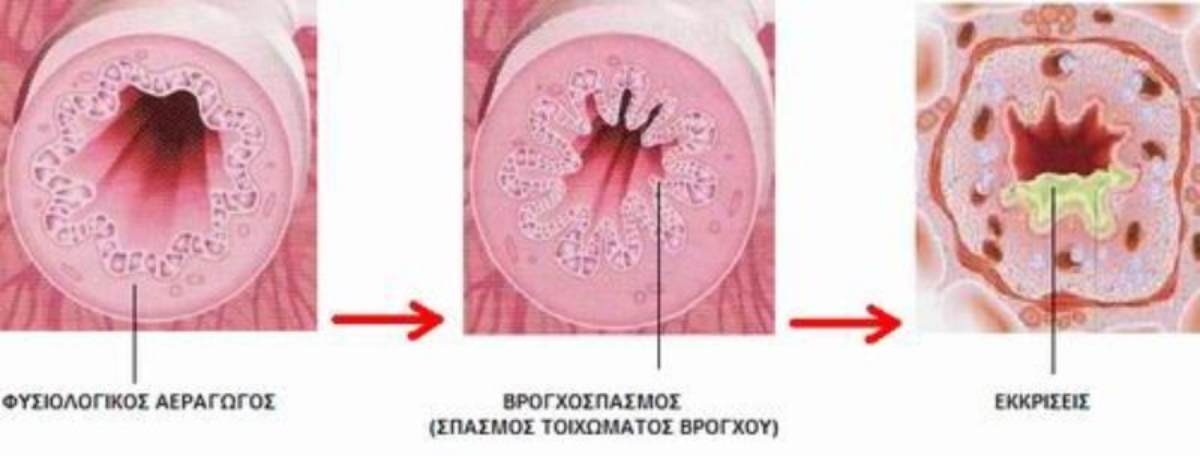 Οι αεραγωγοί υφίστανται συνεχή φλεγμονώδη καταπόνηση