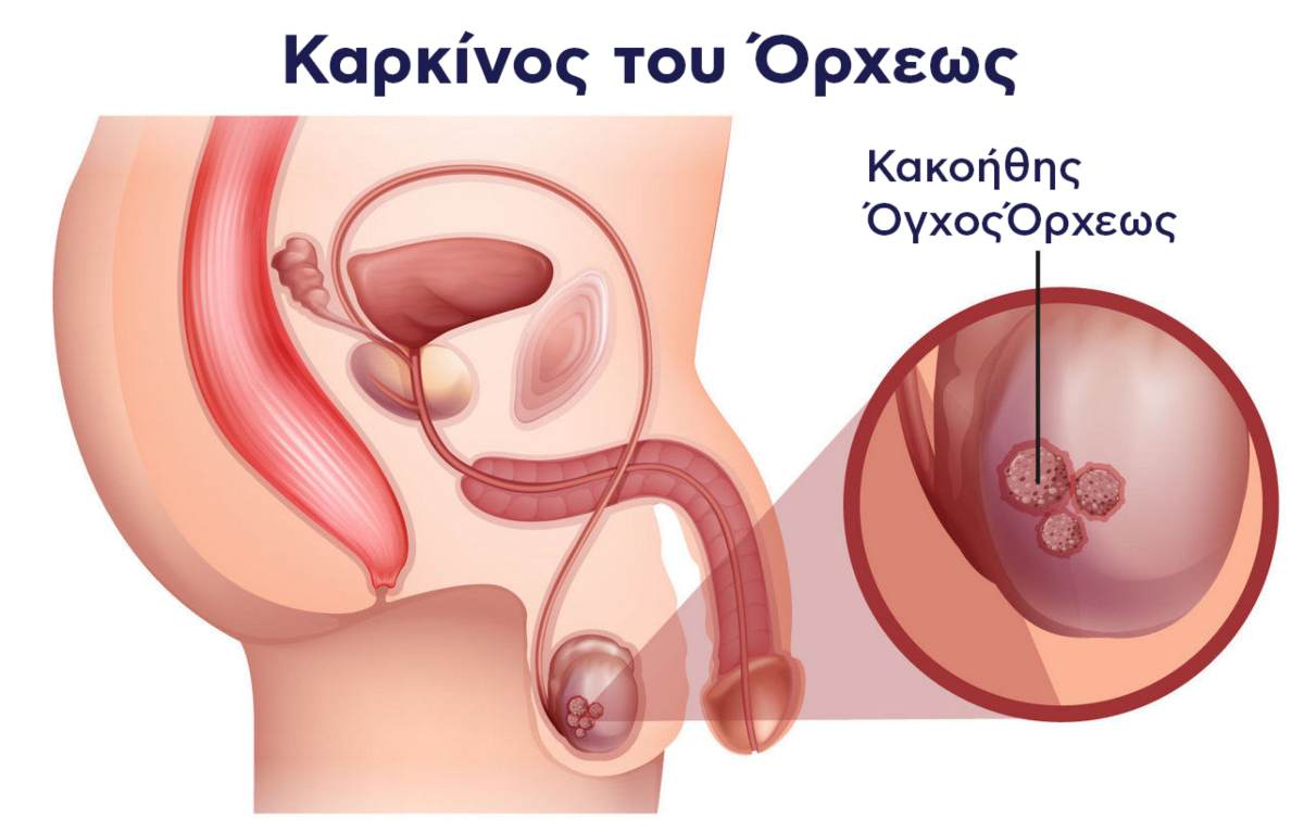 Βρέθηκε αντιμέτωπος με μια διάγνωση που κανείς δεν περιμένει σε αυτή την ηλικία: καρκίνο των όρχεων