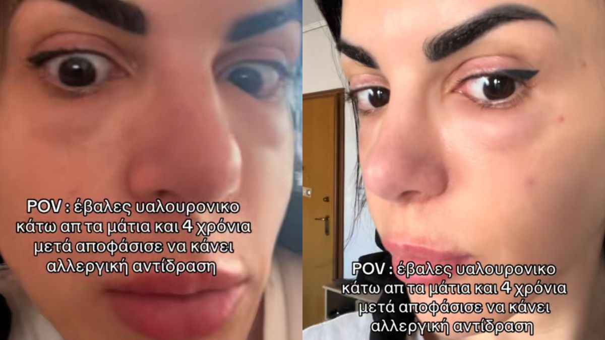 Έβαλε υαλουρονικό κάτω απ’ τα μάτια και δείτε τι έπαθε μετά από τέσσερα χρόνια