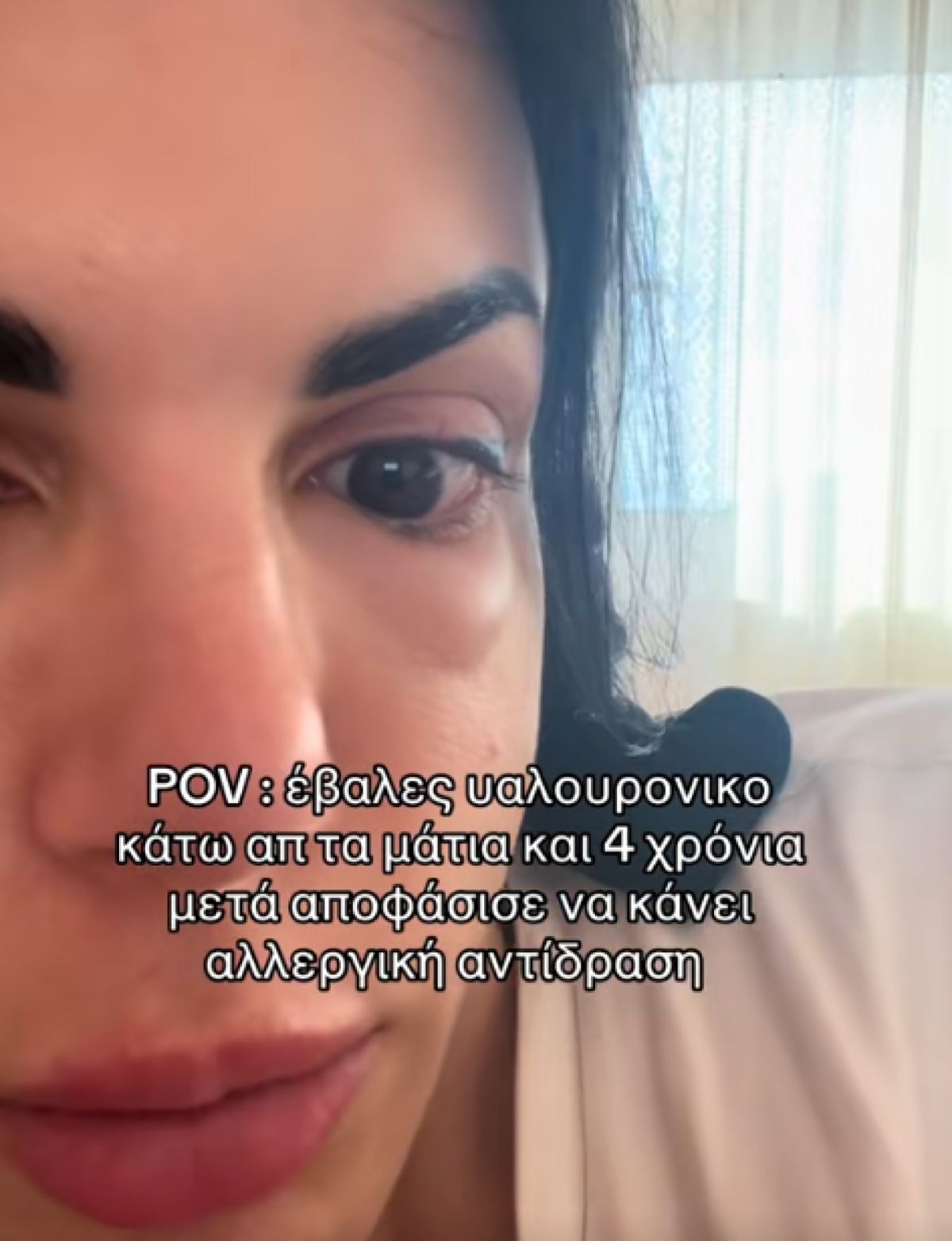 Η viral ιστορία γυναίκας που εμφάνισε πρήξιμο χρόνια μετά από αισθητική παρέμβαση