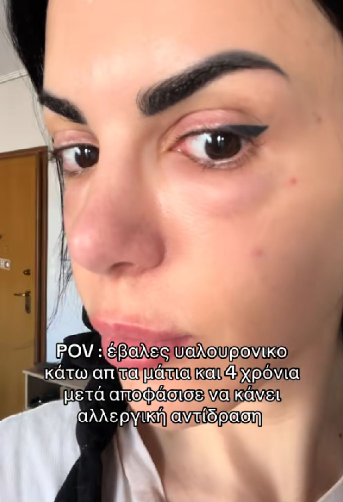 Η αισθητική επέμβαση που έγινε viral για όλους τους λάθος λόγους