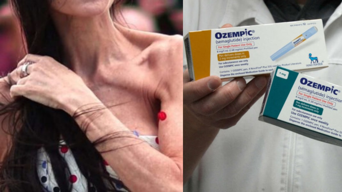 Αυτό που κανείς δεν λέει για το Ozempic: Τι συμβαίνει όταν κόβεις τις ενέσεις