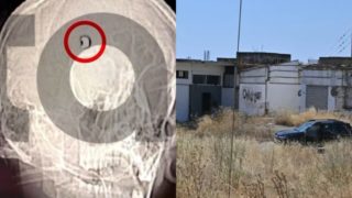 Όλα τούμπα στο Άργος: Η μαγνητική του 20χρονου δείχνει τη σφαίρα στο κεφάλι – Είναι ευθεία βολή και όχι εξοστρακισμός;