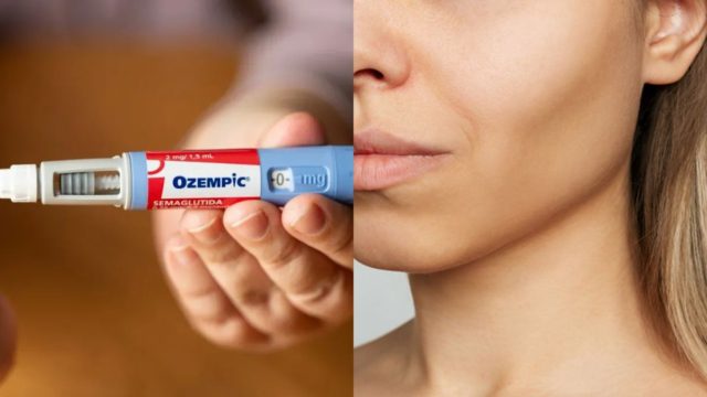 Έχασαν κιλά και στρέφονται στο botox: Η παρενέργεια του Ozempic που φέρνει χρυσές δουλειές στις εταιρείες αισθητικής