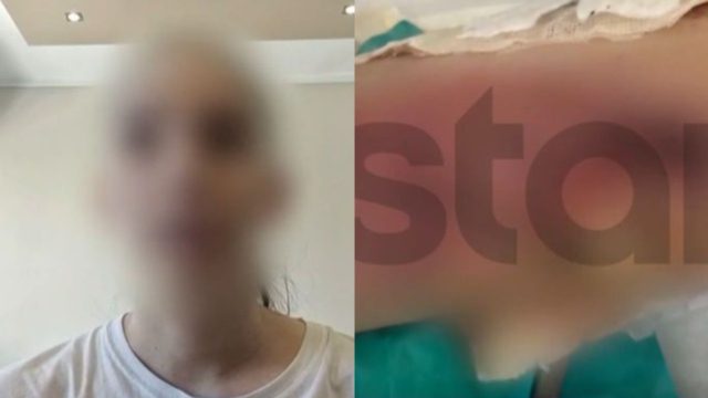Συγκλονίζει η γυμνάστρια στην Θεσσαλονίκη: «Είχα γαντζωθεί στο κρεβάτι, έβραζαν τα πόδια μου», καταγγέλλει η 20χρονη, δείτε βίντεο