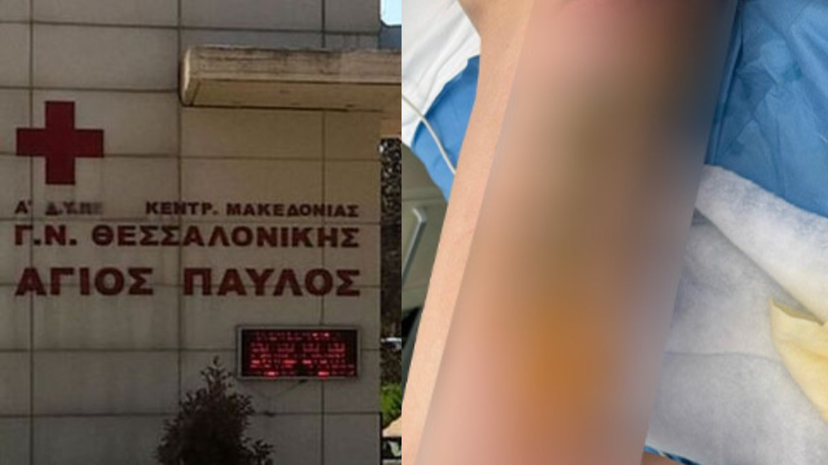 Έζησε την «κόλαση» σε νοσοκομείο της Θεσσαλονίκης: Κοπέλα μπήκε στο χειρουργείο και κατέληξε με εγκαύματα 3ου βαθμού