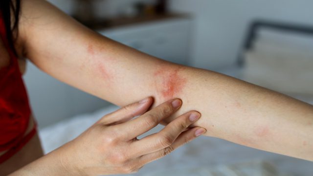 Τσίμπημα εντόμου: Τα σημάδια που δείχνουν ότι μπορεί να κρύβουν σοβαρό κίνδυνο