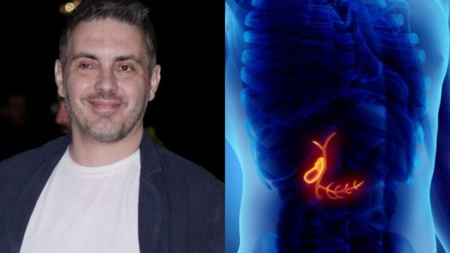 Χολοκυστεκτομή: Τι είναι η επέμβαση στην οποία υποβλήθηκε ο Μιχάλης Χατζηγιάννης – Τα συμπτώματα, οι επιπλοκές και η θεραπεία