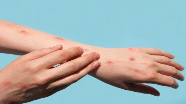 Πενσιλβάνια: Δύο νεκροί από ιλαρά – Οι πρώτοι θάνατοι εδώ και 35 χρόνια
